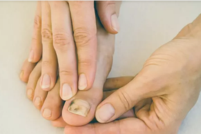Dấu hiệu “lạ” ở ngón chân cảnh báo tế bào ung thư lộ diện