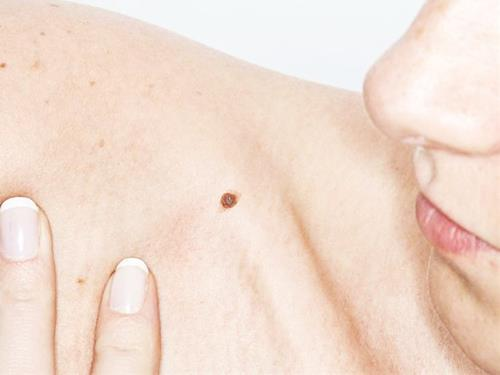 Top 28 nốt ruồi ở cầu vai tốt nhất hiện nay 3 Nốt ruồi trên vai, ngày mai nặng gánh: Nốt ruồi ở đây nói lên điề
