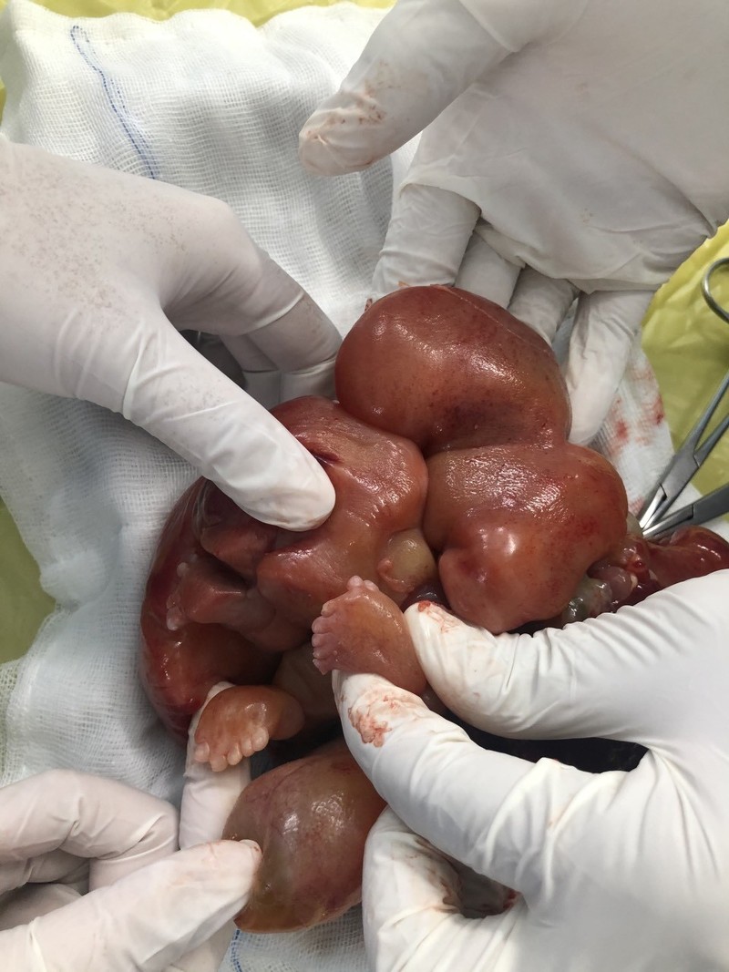 Sức khỏe - Phẫu thuật thành công trường hợp nghi ngờ thai trong thai cực hiếm gặp (Hình 2).